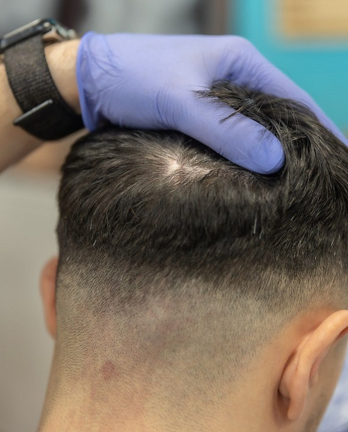 Antes de Micropigmentación Capilar