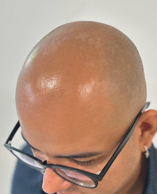 Antes de Micropigmentación Capilar