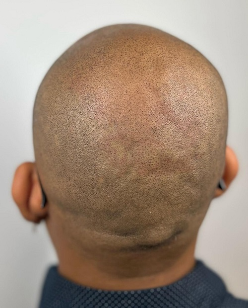 Resultado de Micropigmentación Capilar