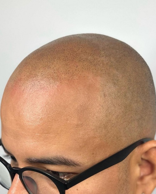 Después de Micropigmentación Capilar