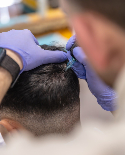 Proceso de Micropigmentación Capilar