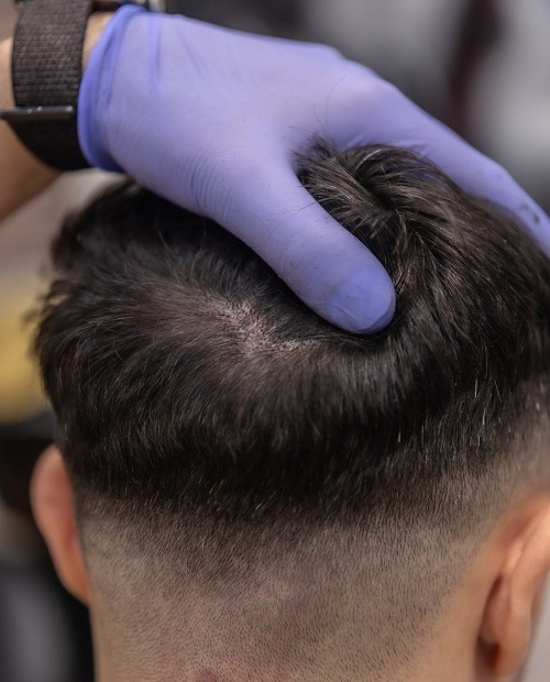 Antes de Micropigmentación Capilar