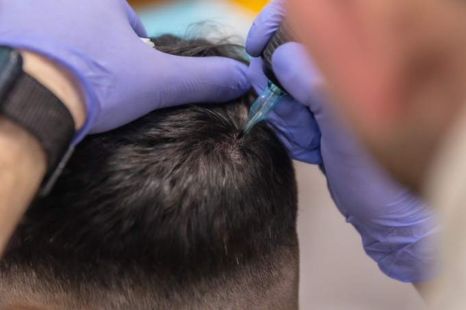 Proceso de Micropigmentación Capilar
